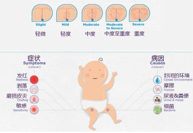 不同程度的尿布疹要选择不同处理方式 如果宝宝皮肤出现渗出液的话