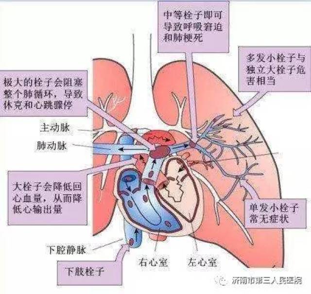 医院动态 | 又见急性肺栓塞,超声诊断帮大忙 ——市三院成功救治一名