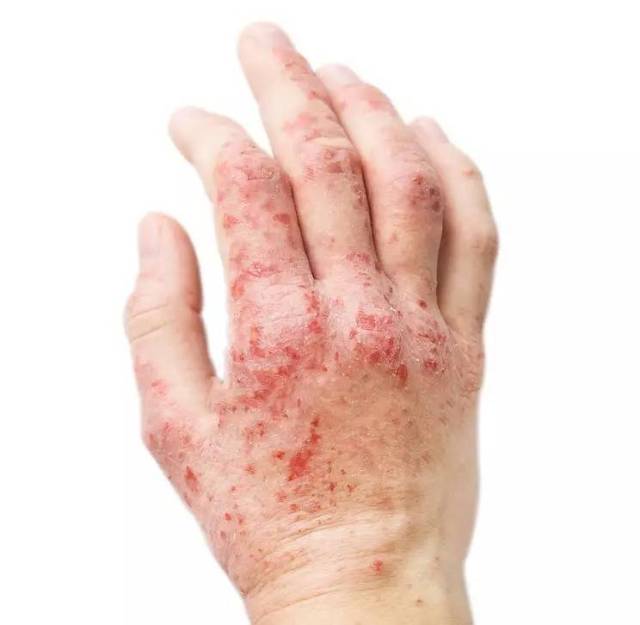 南充润和专家揭秘:身上起红疙瘩很痒是什么病