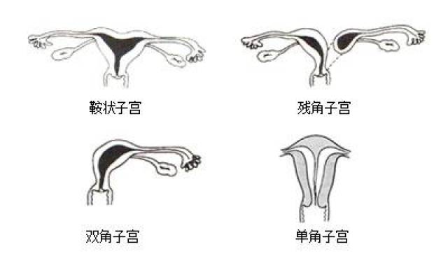 先天性子宫体异常如双角子宫,单角子宫,子宫纵膈之外,子宫肌瘤,子宫