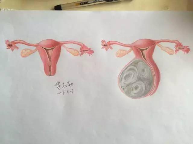 下面是她画的一张手术标本绘制的解剖图,左边是正常子宫,右边是根据她