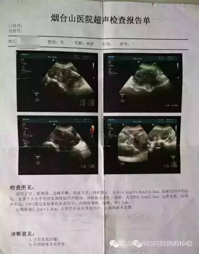 葆婴 案例分享 ~ 多发性子宫肌瘤