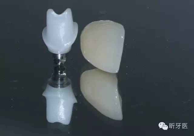 成品基台制作树脂临时冠,螺丝固位,软组织塑形 牙齿戴入即刻,形态