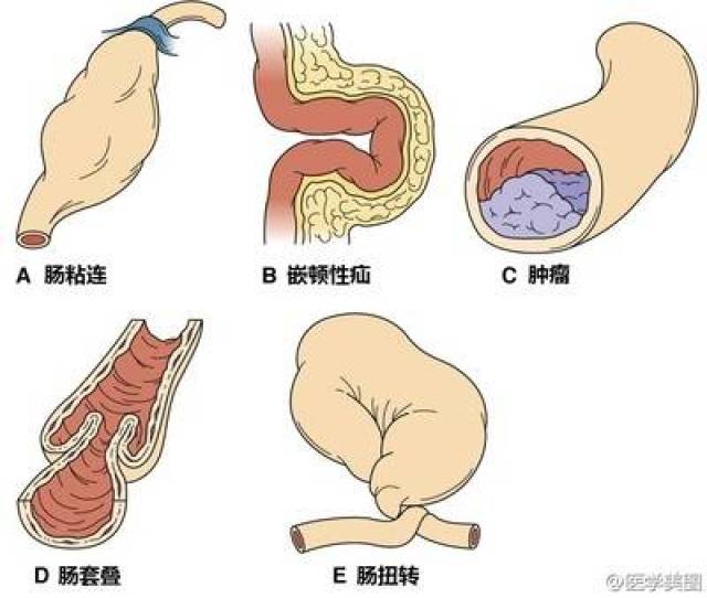 ⑧肠扭转:扭转多见于肠系膜肿瘤或其基底部狭窄等原因所致.