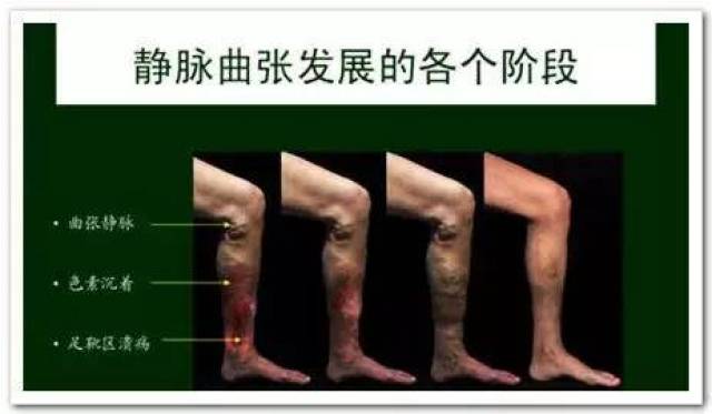 静脉曲张的治疗