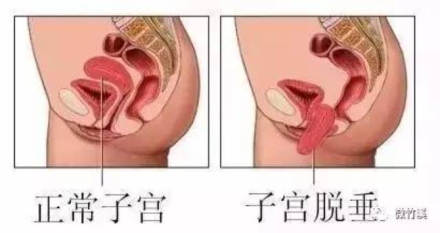 县妇幼保健院引进法国盆底康复仪,让产后妈妈更健康!