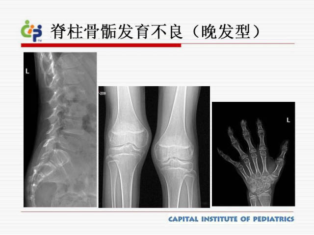 假性软骨发育不全的概念与x线表现 2.