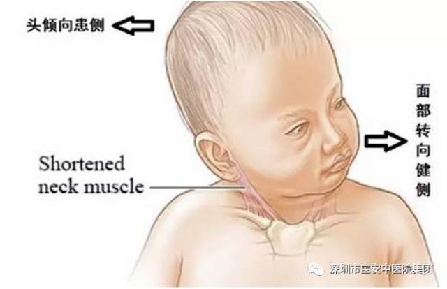 5,先天性肌斜颈的分型