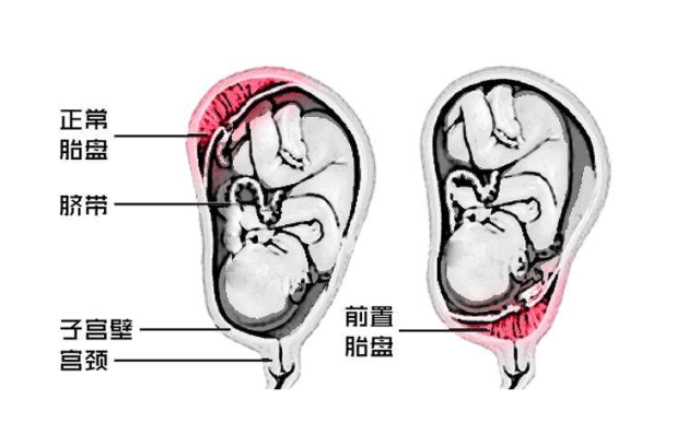 胎盘前置生娃,真是一命换一命,保大还是保小,婆婆怎么选?