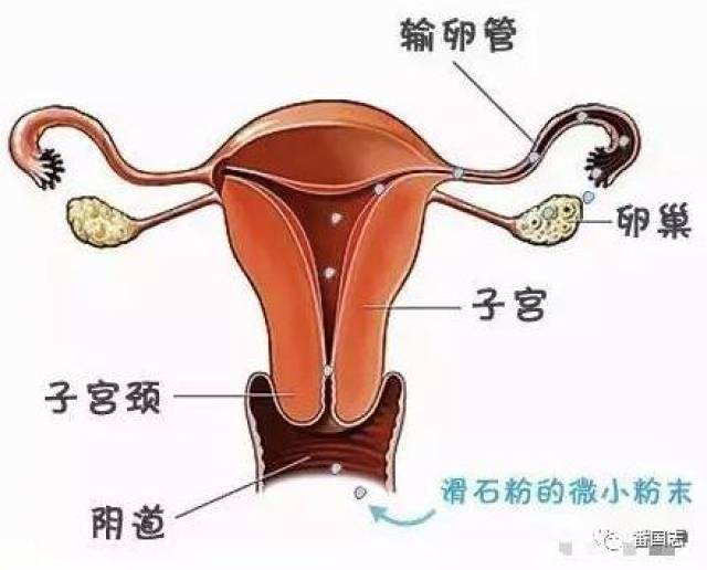 美国女子因这款明星产品罹患卵巢癌
