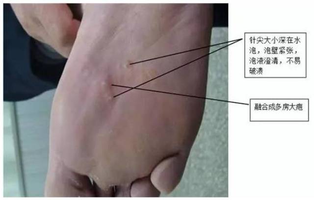 手足癣长什么样 按照临床特点,可分为水疱鳞屑型,角化过度型和浸渍