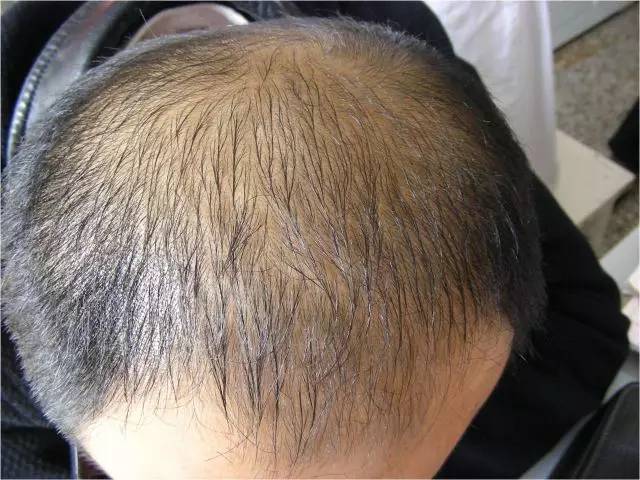 4,梅毒性脱发:虫蚀样脱发