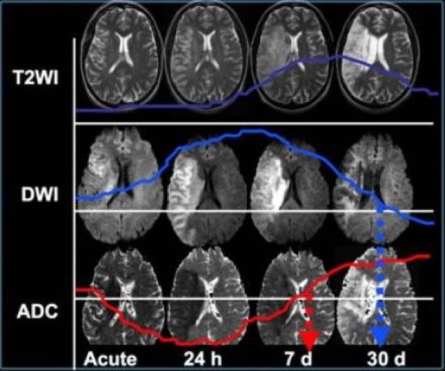 【相关专业】一文理清脑梗死 dwi 表现|临床基础