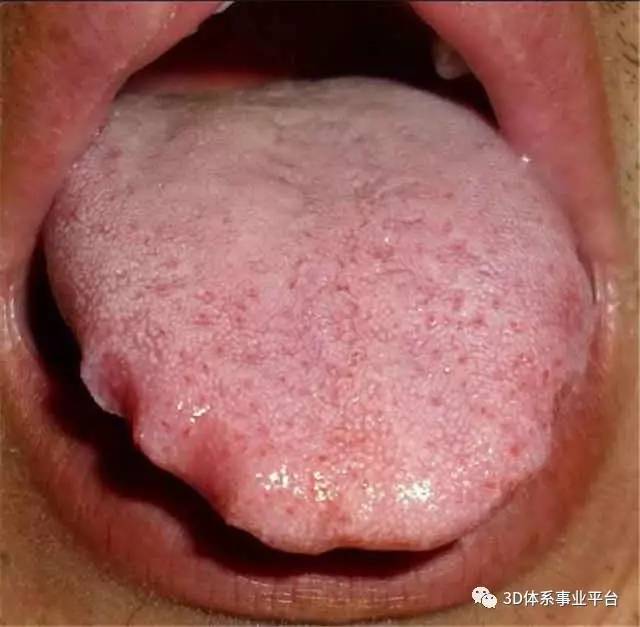 正常的,如果舌苔颜色过于发白发黄,并且比较厚实的,则表明体内湿气