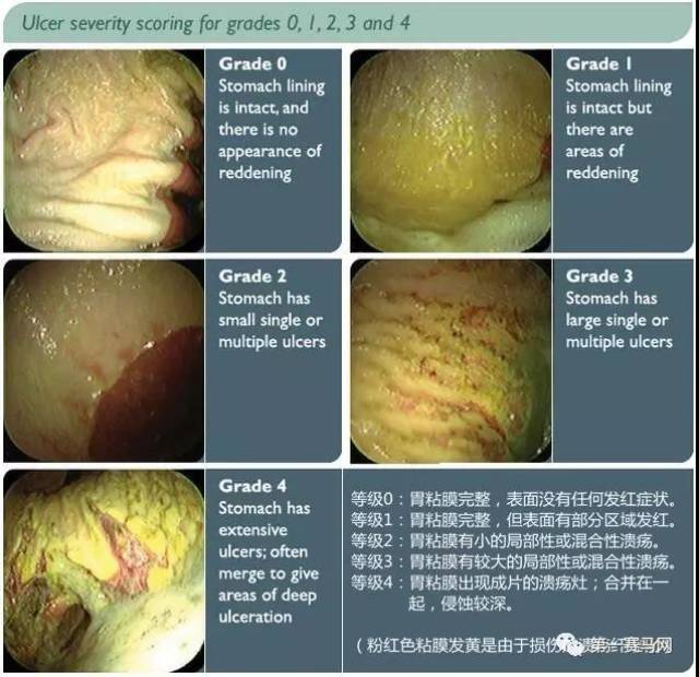 治疗前后胃窥镜下非腺体区视野