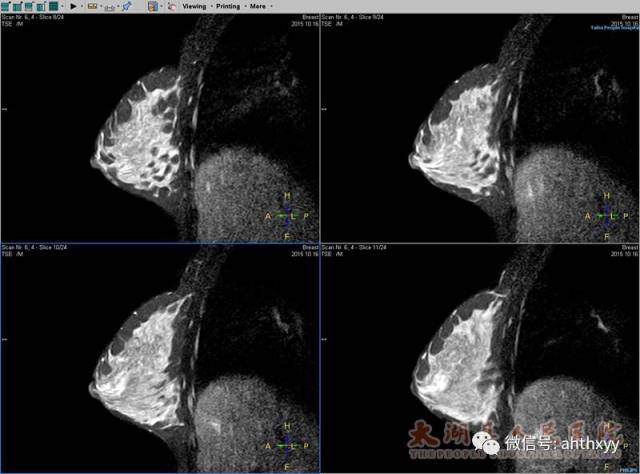 医学影像科成功开展乳腺磁共振功能成像及动态增强新技术