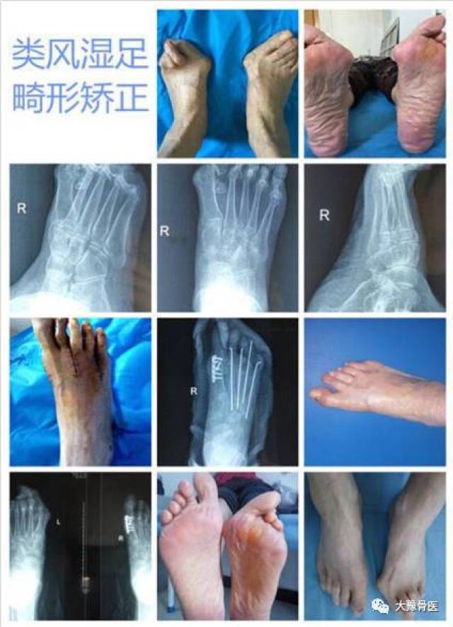 穿合脚的鞋 圆类风湿足部畸形患者的梦——记河南省足踝专家第83次