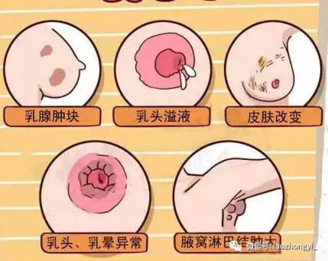 ⑤副乳:腋下淋巴结不畅,内衣穿着不恰当  ⑥乳房青筋:肝火旺,性情急