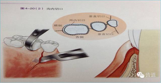 可根据患者和病损区实际情况灵活选择沟内切口,内斜切口,保留龈乳头