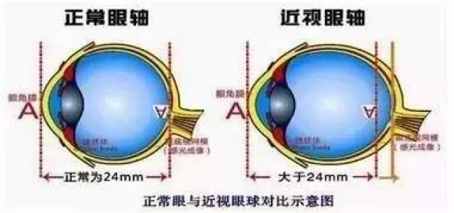 其中轴性近视就是眼球的前后直径延长,给人看起来眼球有往外凸的外观