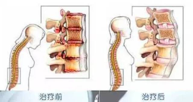 青少年多发病!孩子腰背痛可能是患上了强直性脊柱炎