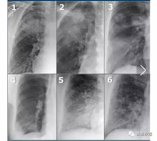 【x线诊断要点】肺水肿,肺栓塞和肺梗死(结合ct)下