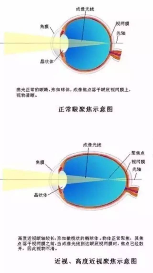 孩子眼轴增长过快,最终超过24mm,那就形成了近视,而且是不可逆的