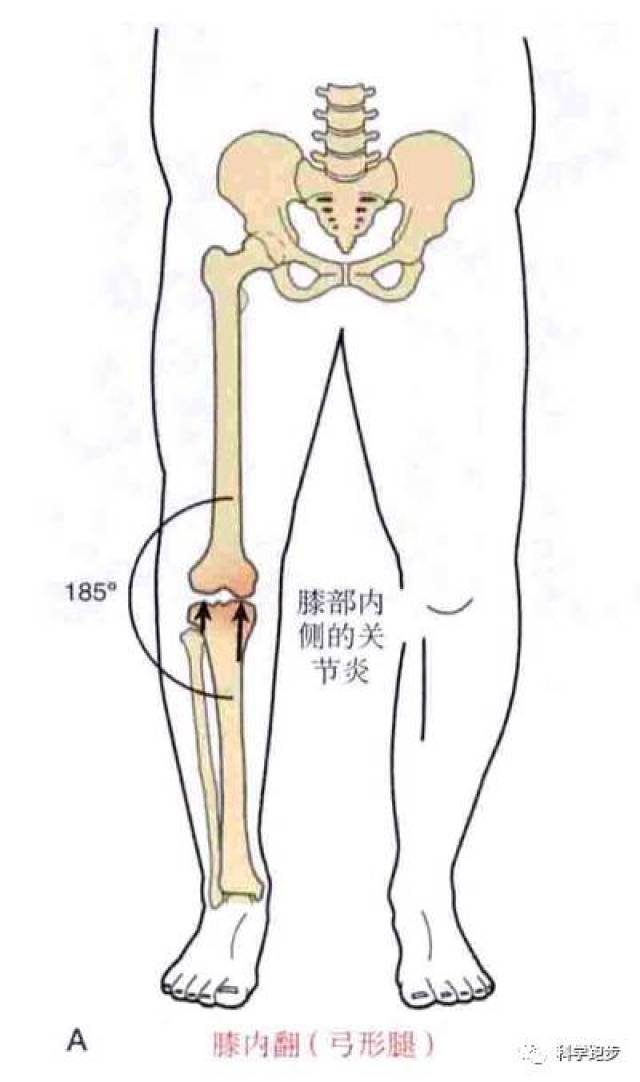 跑步为什么会膝盖疼-x,o型腿(连载1)