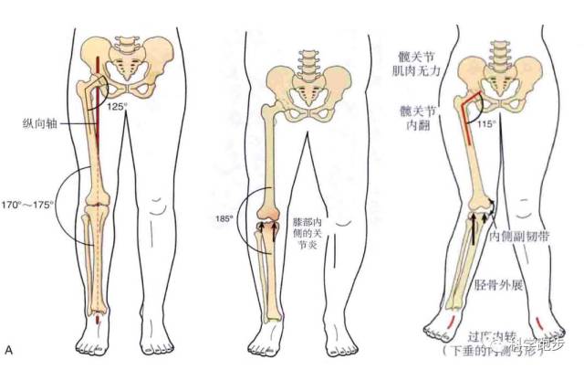 跑步为什么会膝盖疼----x,o型腿(连载1)