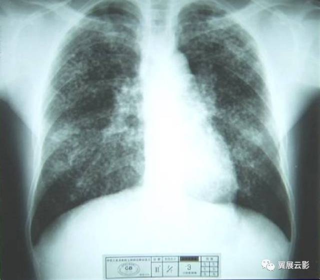 尘肺的影像表现及鉴别诊断