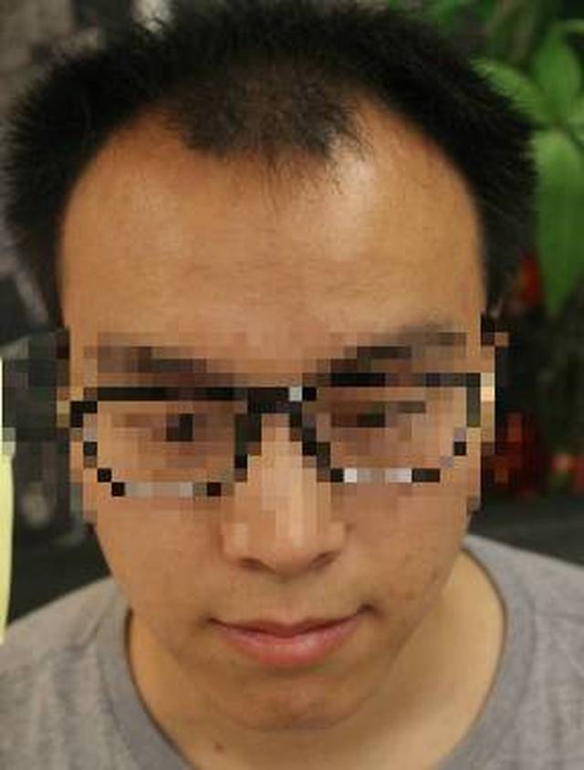 秃顶10年"大叔"逆袭小鲜肉,脱发,秃顶,m型脱发.这样做可以统统解决!