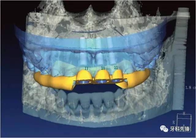 上颌多颗相邻前牙的"精确化"即刻种植修复