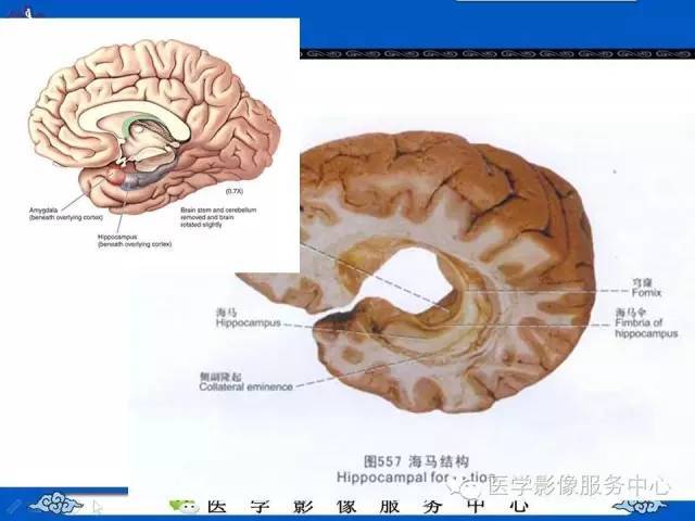 精彩幻灯 | 海马的解剖及萎缩分级