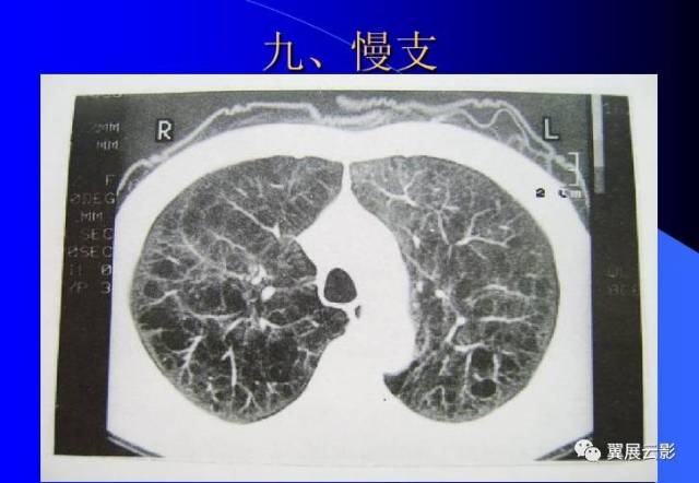 尘肺的影像表现及鉴别诊断