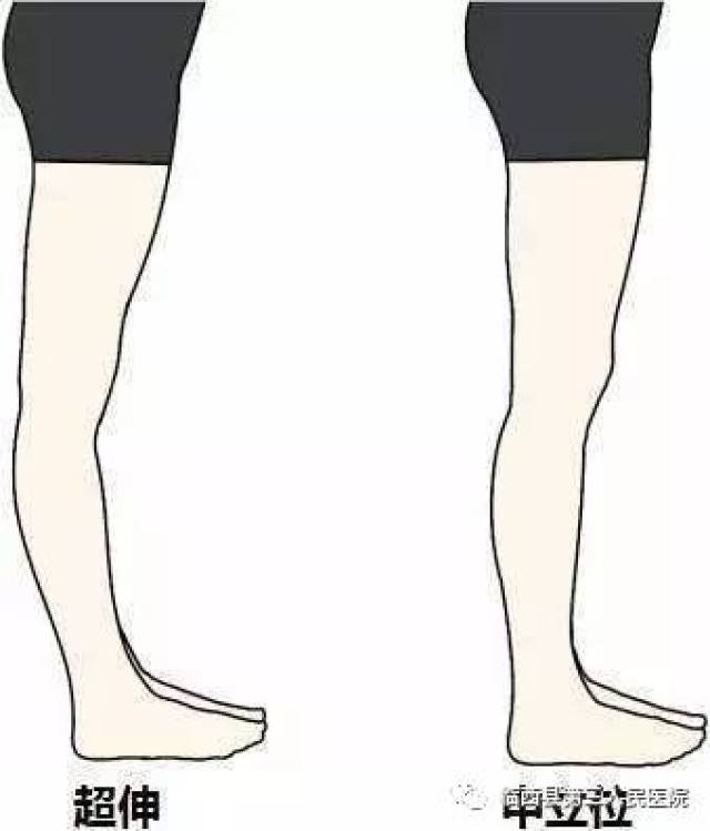 顶端相对于股骨向后滑动,使得膝关节向后过度打开,侧面看呈后凸的弧形