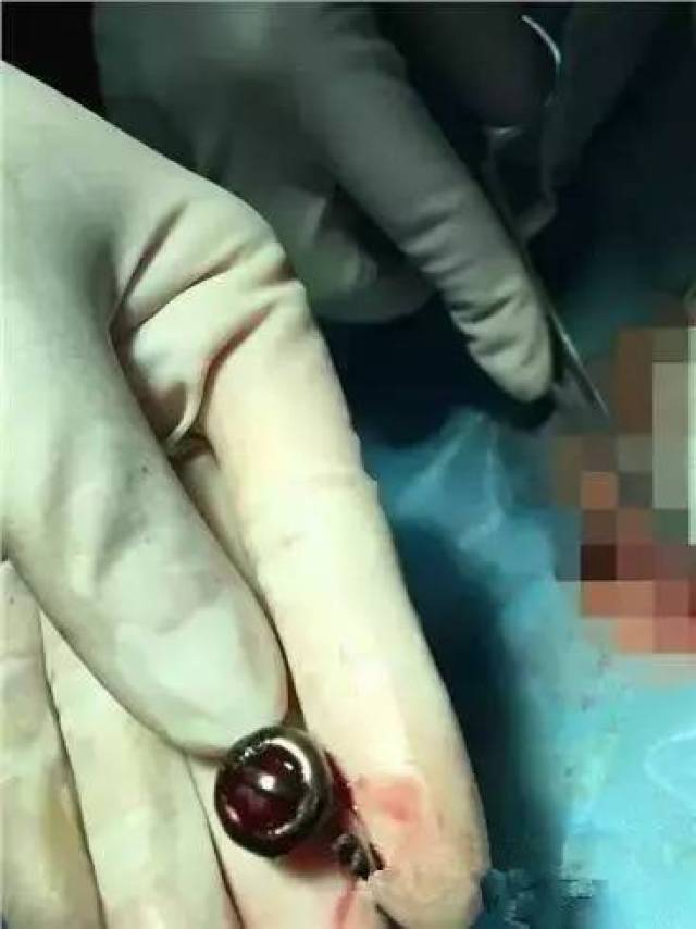 心塞丨熊孩子竟把26颗这个塞进"小鸡鸡",而6岁女童体内竟被塞入铃铛.