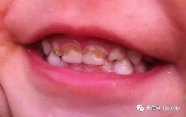 奶瓶龋在初期时候症状不明显,主要是门牙根部会出现白垩色脱矿带.