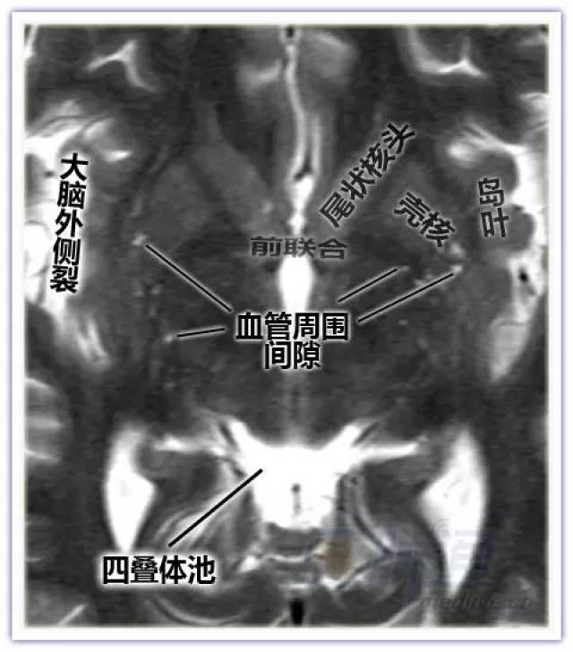 【相关专业】简明易懂的脑部断层解剖图谱,快来收藏!