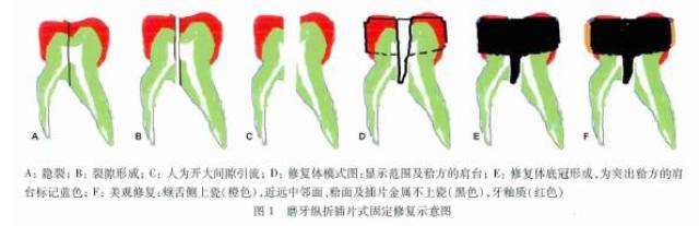     磨牙纵折是临床上常见的牙体