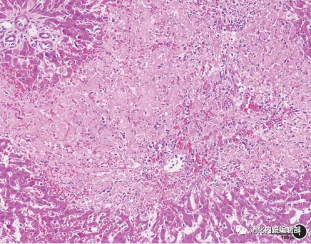 内皮细胞损伤,窦壁破坏;其中,肝腺泡Ⅲ区血窦淤血,肝板结构破坏,肝
