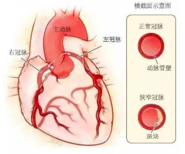 解剖,右侧为冠脉粥样病变病理图示 3 "沉默型"冠心病检测都有哪些项目