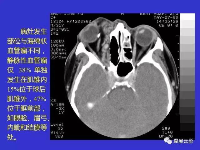 眼眶肿瘤的ct诊断和鉴别诊断