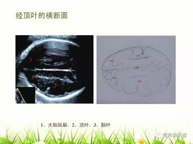 【图示 手绘】读懂正常胎儿颅脑超声