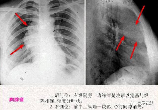 详解纵隔肿瘤以及鉴别诊断