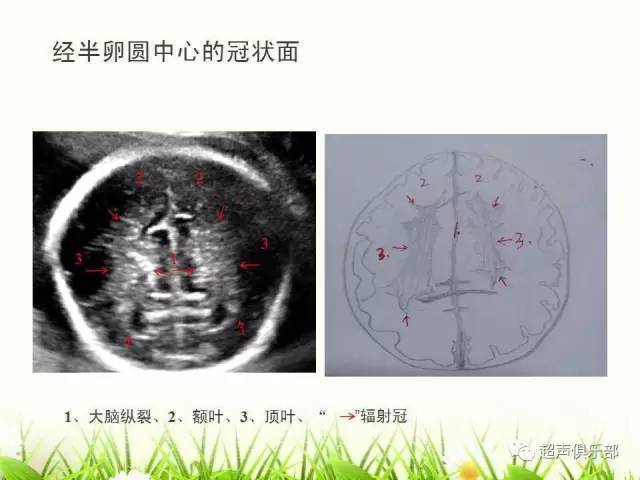 【图示 手绘】读懂正常胎儿颅脑超声