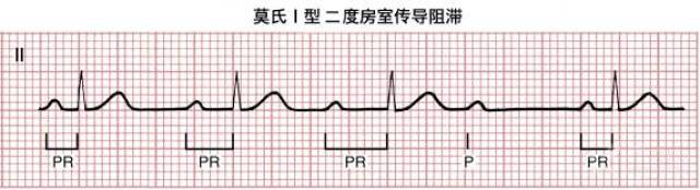 看心电图揪「拦路虎」:谈谈房室传导阻滞