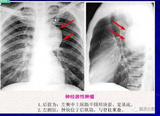 详解纵隔肿瘤以及鉴别诊断