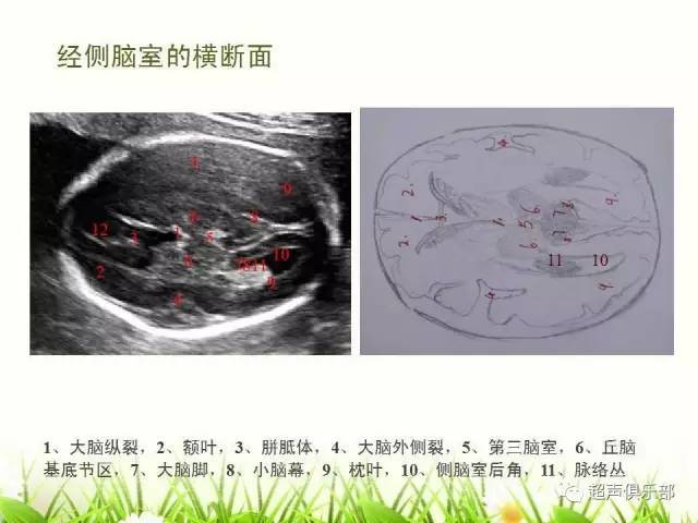 【图示 手绘】读懂正常胎儿颅脑超声