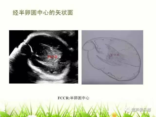 【图示 手绘】读懂正常胎儿颅脑超声