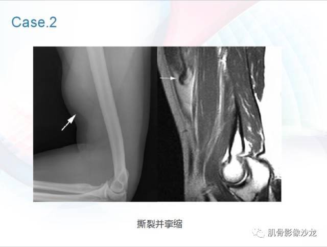 肘关节运动损伤的影像诊断